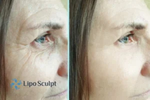 How to Fight Aging Symptoms 2 Do you want to Fight Aging Symptoms Essex? Contact Lipo Sculpt today!