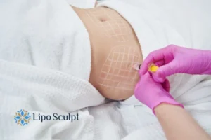 Are The Results From Aqualyx Permanent? 1 Do you want to know how long Aqualyx Essex results last?