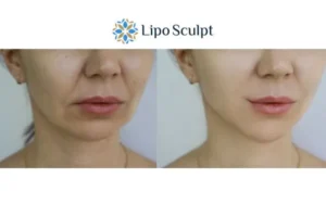 Explaining Morpheus8 And What It Can Do For You 2 Do you want to boost your self confidence? Give Morpheus8 Essex a try today!