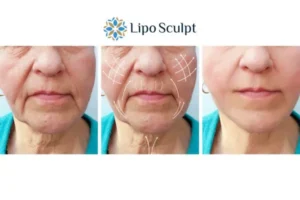 Explaining Morpheus8 And What It Can Do For You 3 Boost your confidence with Morpheus8 Essex call our team today!